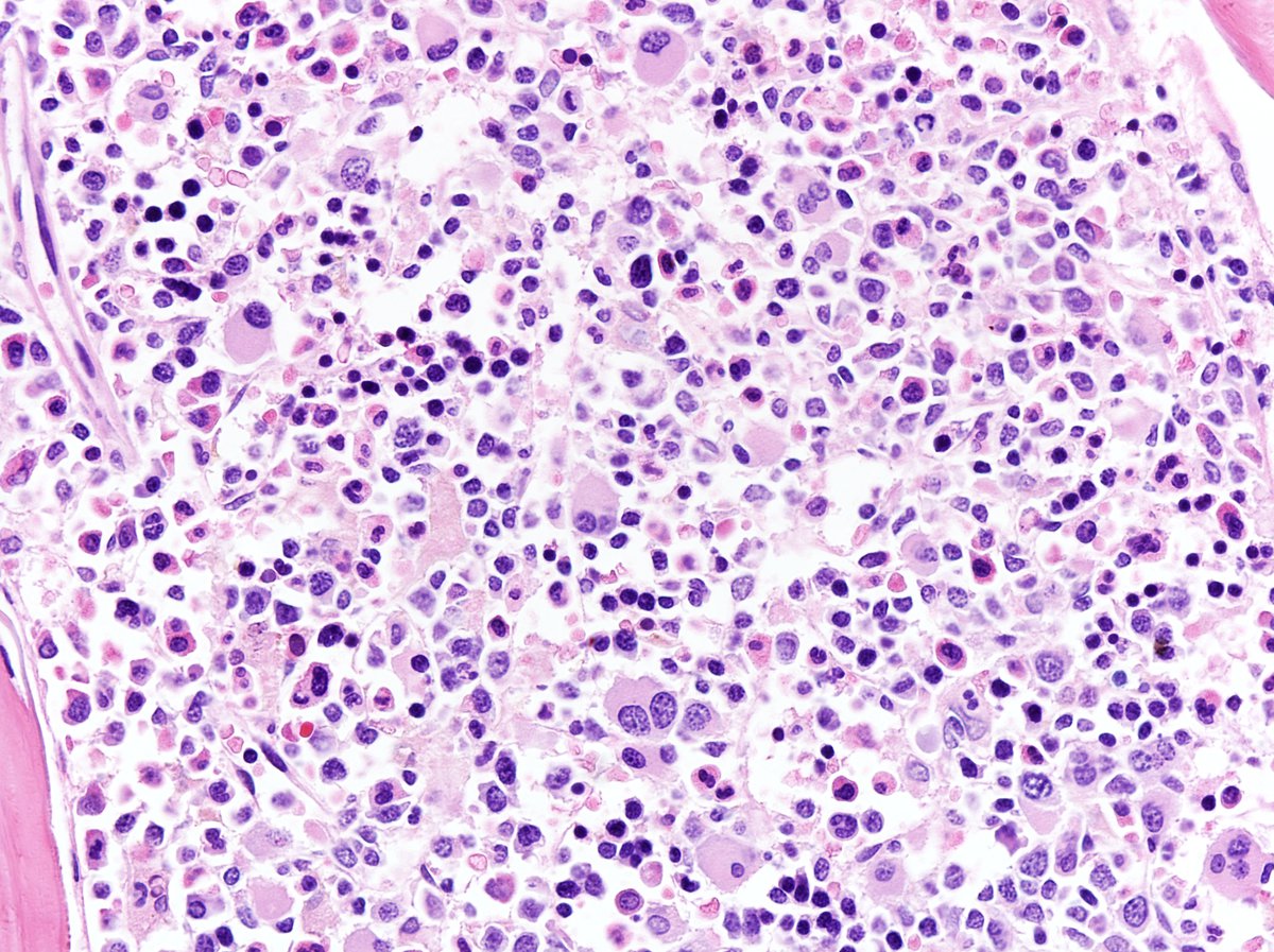 Patient’s first marrow biopsy (1998, not submitted): High power image showed dwarf/hypolobated megakaryocytes. 
